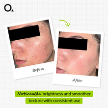 Azelaic Acid Suspension 10% 30 Ml